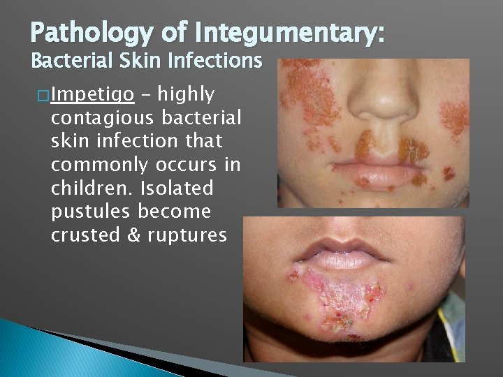 Pathology of Integumentary: Bacterial Skin Infections � Impetigo – highly contagious bacterial skin infection