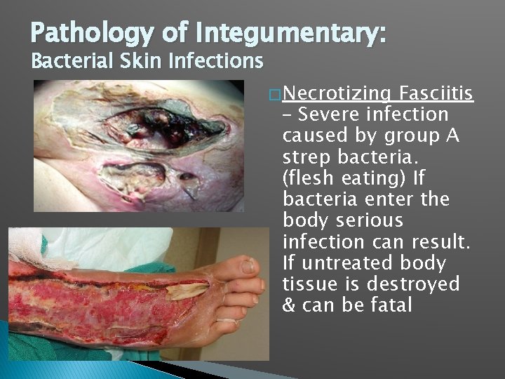 Pathology of Integumentary: Bacterial Skin Infections � Necrotizing Fasciitis – Severe infection caused by