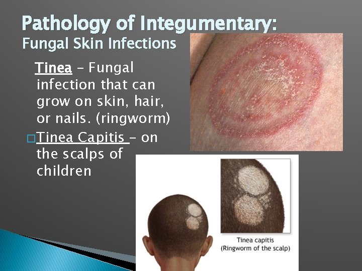 Pathology of Integumentary: Fungal Skin Infections Tinea – Fungal infection that can grow on