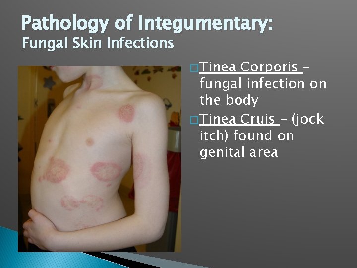 Pathology of Integumentary: Fungal Skin Infections � Tinea Corporis – fungal infection on the