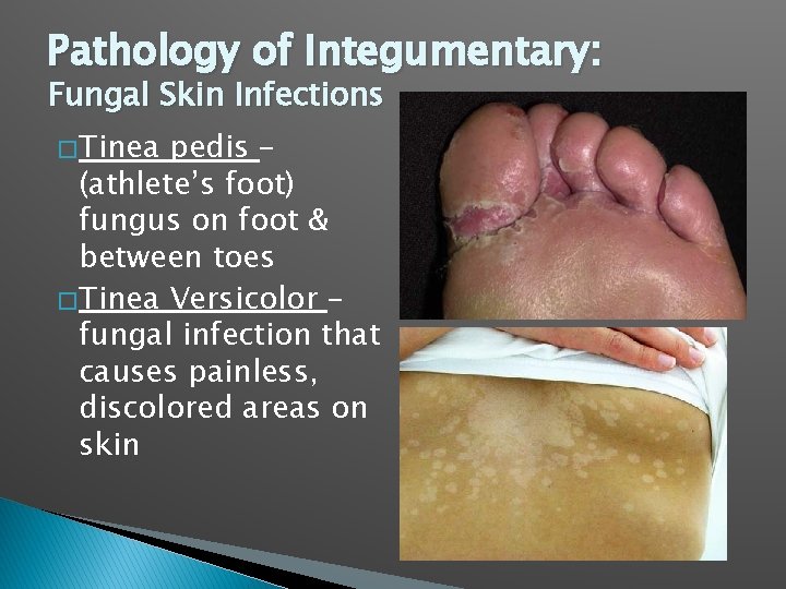 Pathology of Integumentary: Fungal Skin Infections � Tinea pedis – (athlete’s foot) fungus on