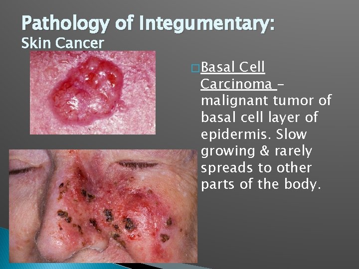 Pathology of Integumentary: Skin Cancer � Basal Cell Carcinoma – malignant tumor of basal