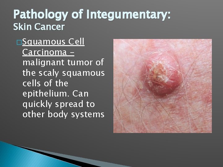 Pathology of Integumentary: Skin Cancer � Squamous Cell Carcinoma – malignant tumor of the