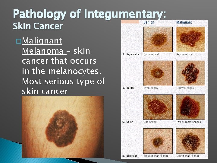 Pathology of Integumentary: Skin Cancer � Malignant Melanoma – skin cancer that occurs in