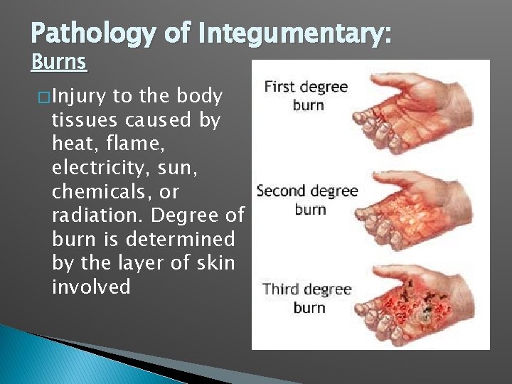Pathology of Integumentary: Burns � Injury to the body tissues caused by heat, flame,