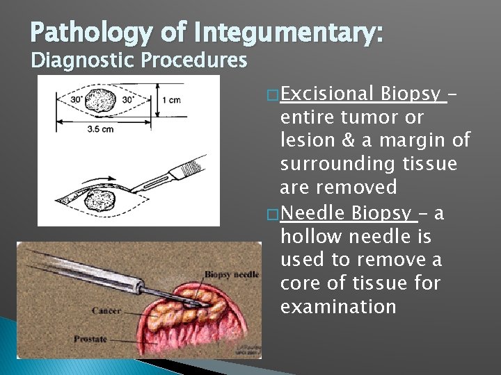 Pathology of Integumentary: Diagnostic Procedures � Excisional Biopsy – entire tumor or lesion &