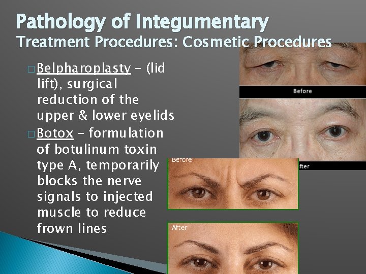 Pathology of Integumentary Treatment Procedures: Cosmetic Procedures � Belpharoplasty – (lid lift), surgical reduction