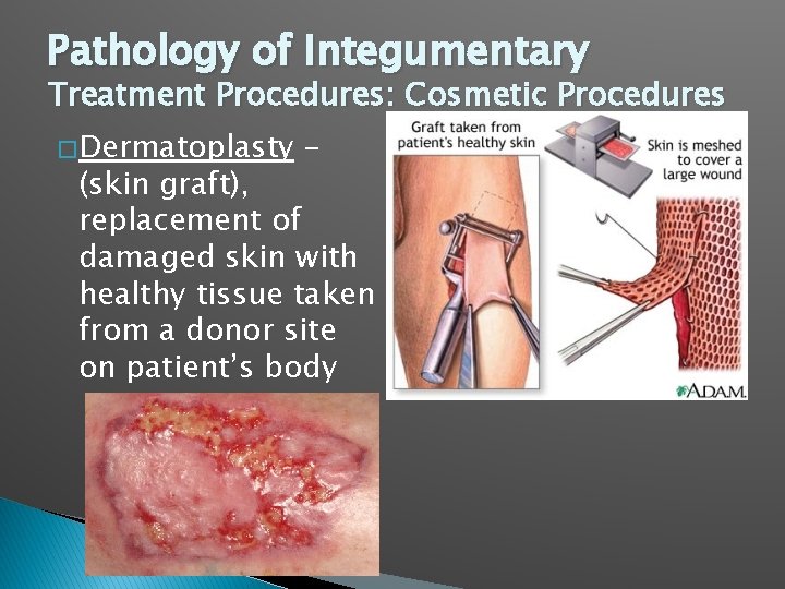 Pathology of Integumentary Treatment Procedures: Cosmetic Procedures � Dermatoplasty – (skin graft), replacement of