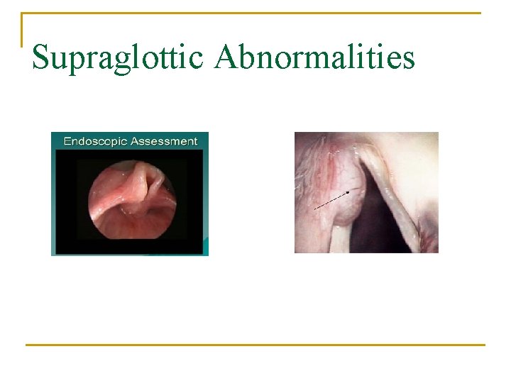 Supraglottic Abnormalities 