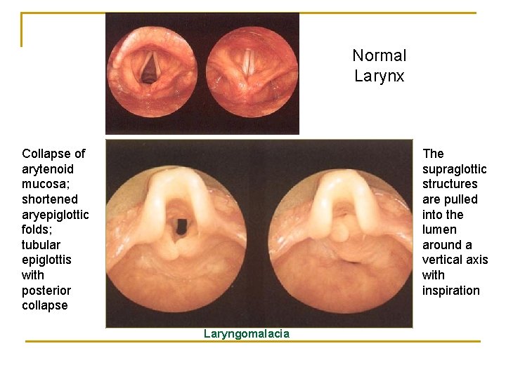 Normal Larynx Collapse of arytenoid mucosa; shortened aryepiglottic folds; tubular epiglottis with posterior collapse