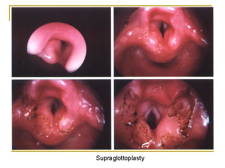Supraglottoplasty 