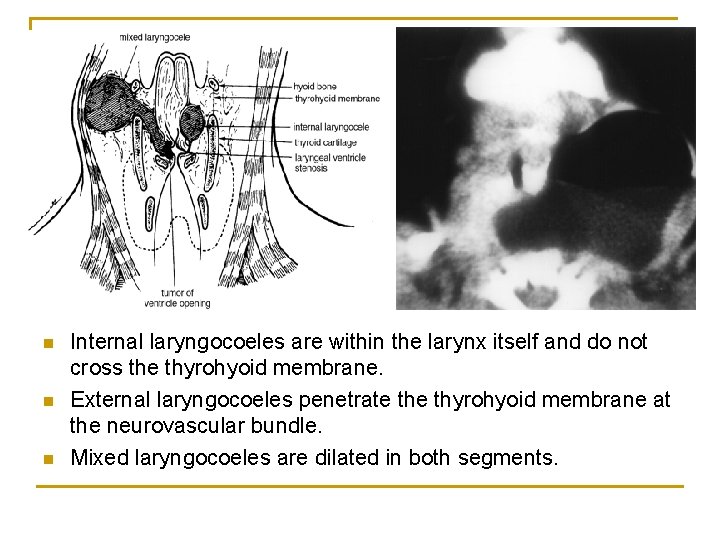 n n n Internal laryngocoeles are within the larynx itself and do not cross