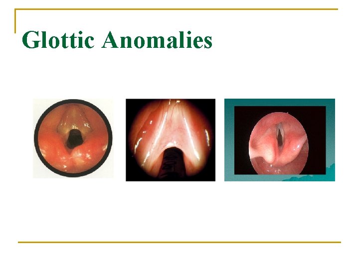 Glottic Anomalies 