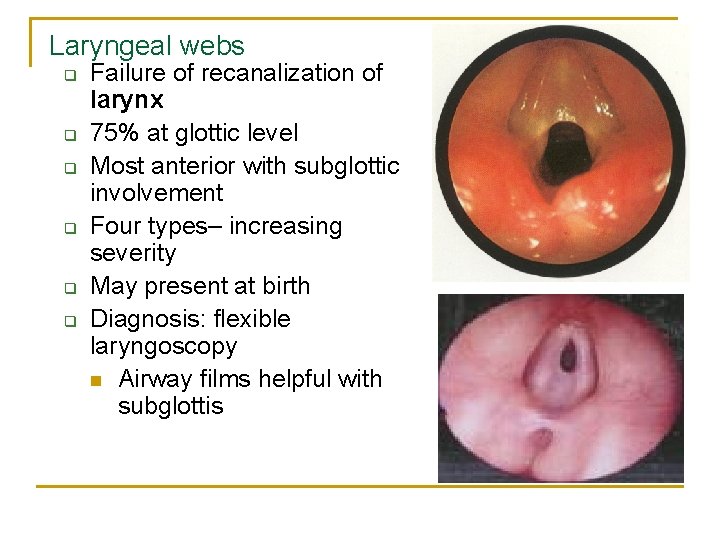 Laryngeal webs q q q Failure of recanalization of larynx 75% at glottic level