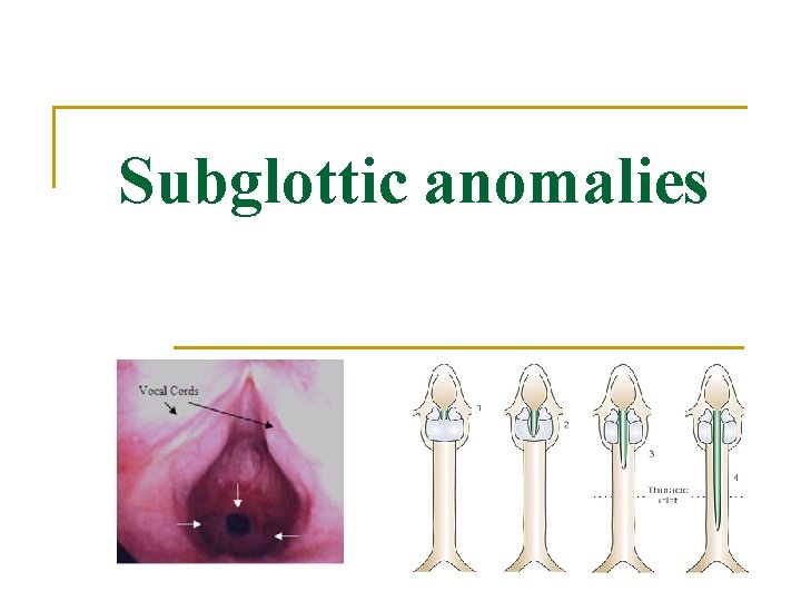 Subglottic anomalies 