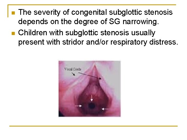 n n The severity of congenital subglottic stenosis depends on the degree of SG
