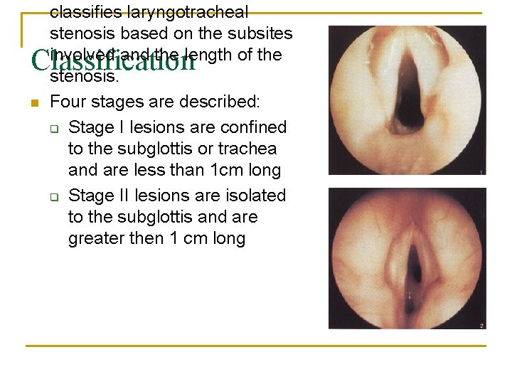 classifies laryngotracheal stenosis based on the subsites involved and the length of the stenosis.