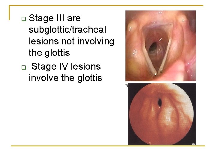 Stage III are subglottic/tracheal lesions not involving the glottis q Stage IV lesions involve