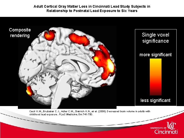 Adult Cortical Gray Matter Loss in Cincinnati Lead Study Subjects in Relationship to Postnatal