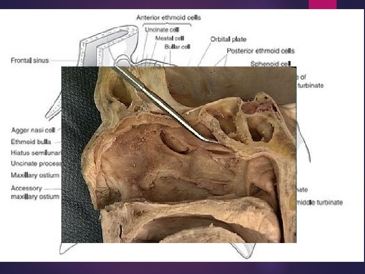 OMC Infundibulum – Infundibulum funnel shaped area whereby the maxillary, ant ethmoid and frontal