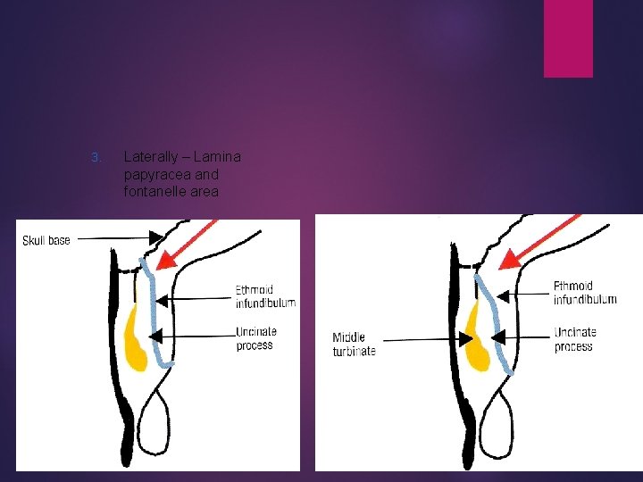 3. Laterally – Lamina papyracea and fontanelle area 