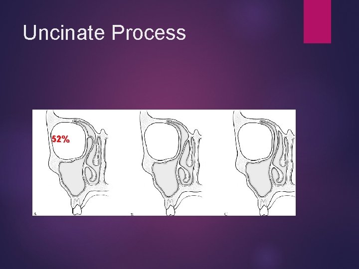 Uncinate Process 52% 