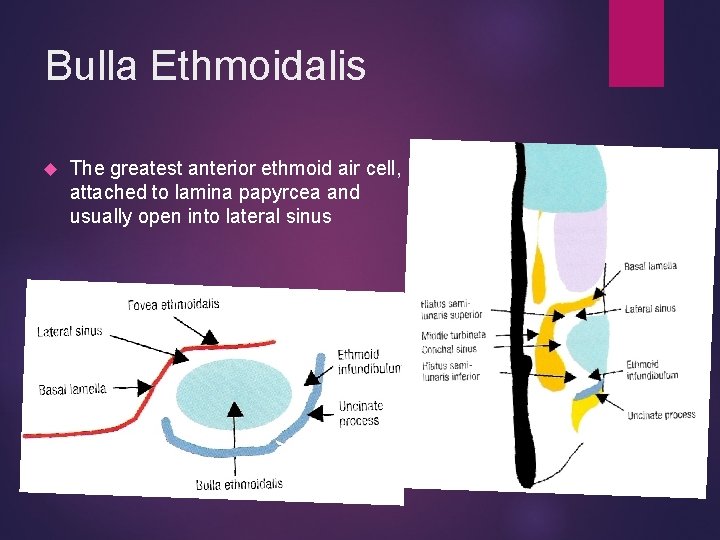 Bulla Ethmoidalis The greatest anterior ethmoid air cell, attached to lamina papyrcea and usually