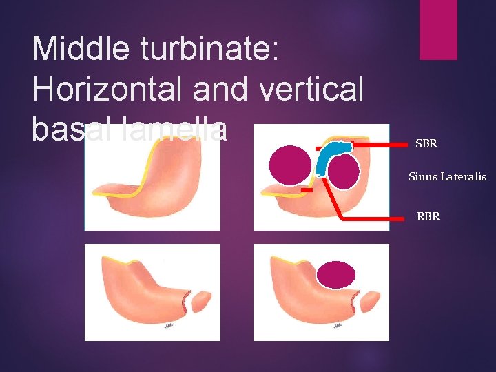 Middle turbinate: Horizontal and vertical basal lamella SBR Sinus Lateralis RBR 