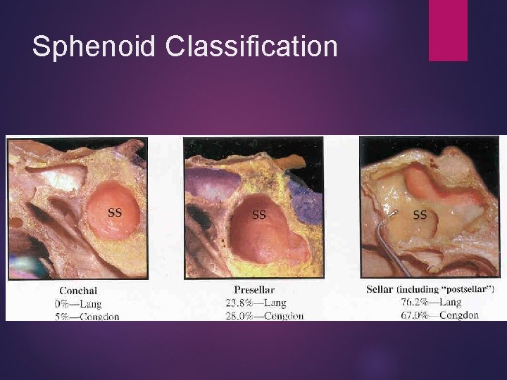 Sphenoid Classification 