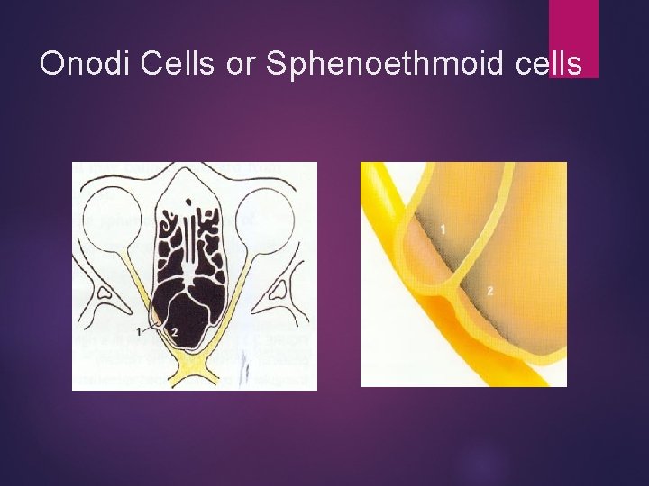 Onodi Cells or Sphenoethmoid cells 