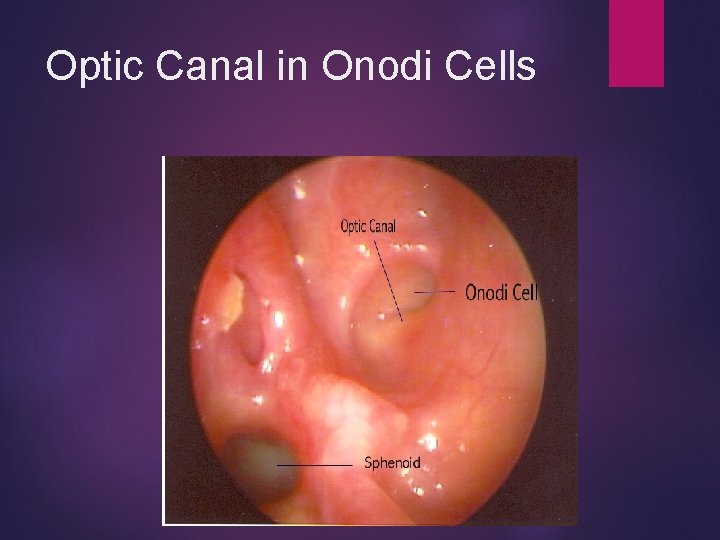 Optic Canal in Onodi Cells 