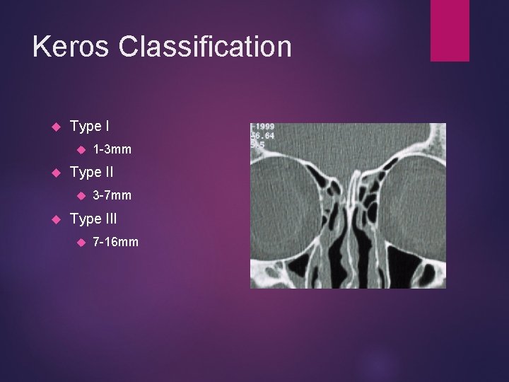 Keros Classification Type II 1 -3 mm 3 -7 mm Type III 7 -16