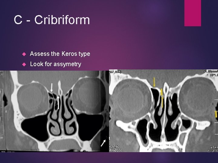 C - Cribriform Assess the Keros type Look for assymetry 