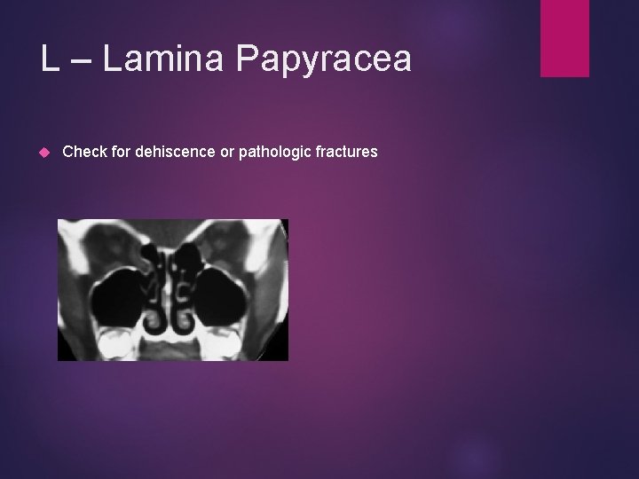 L – Lamina Papyracea Check for dehiscence or pathologic fractures 