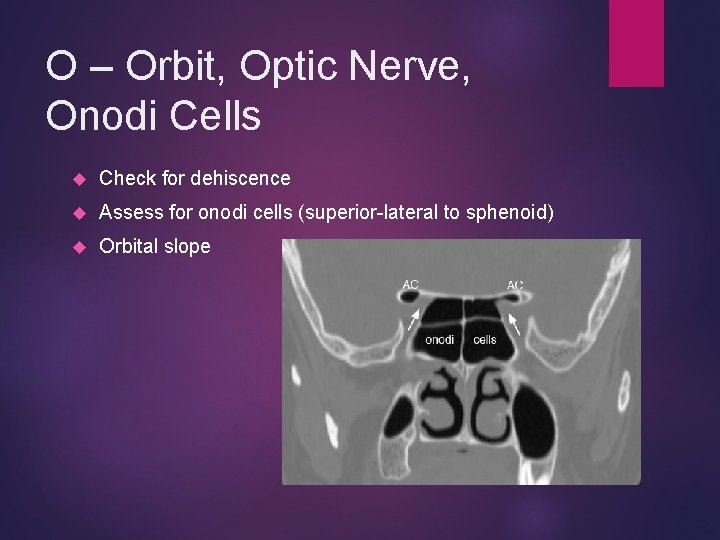 O – Orbit, Optic Nerve, Onodi Cells Check for dehiscence Assess for onodi cells