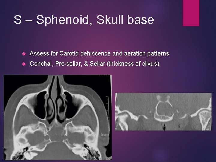 S – Sphenoid, Skull base Assess for Carotid dehiscence and aeration patterns Conchal, Pre-sellar,