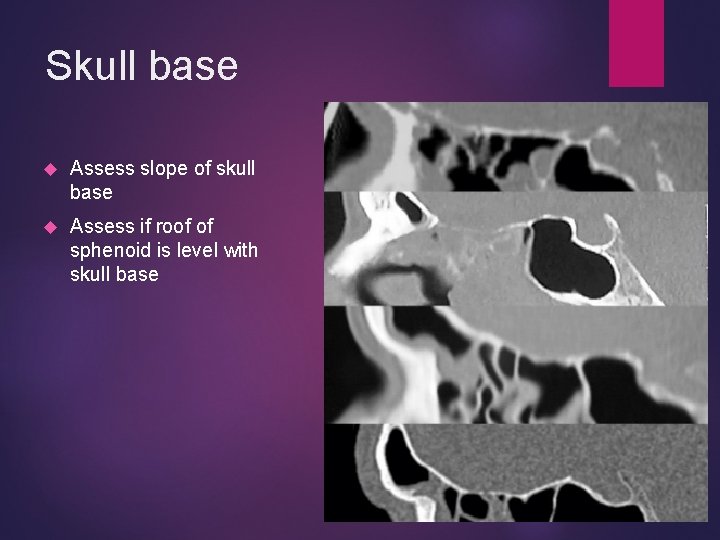 Skull base Assess slope of skull base Assess if roof of sphenoid is level