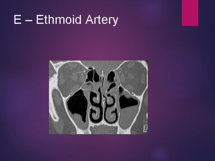 E – Ethmoid Artery 