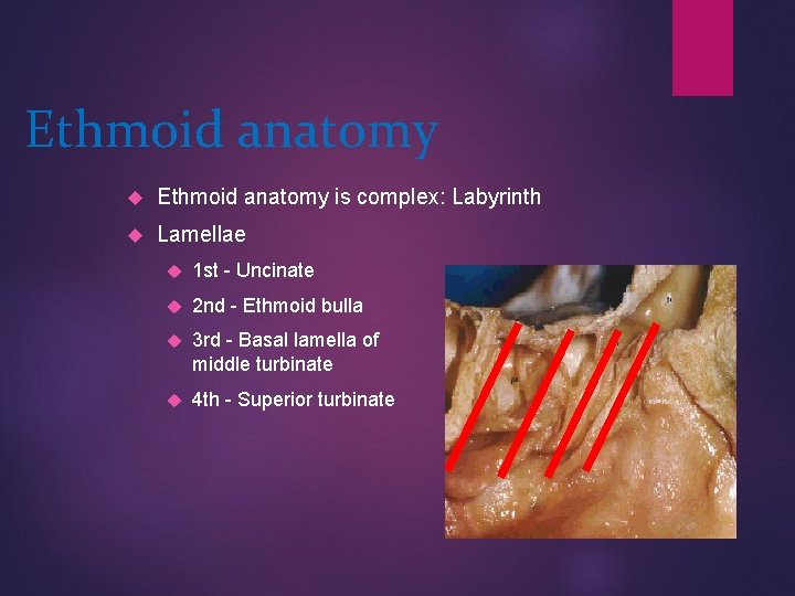 Ethmoid anatomy is complex: Labyrinth Lamellae 1 st - Uncinate 2 nd - Ethmoid