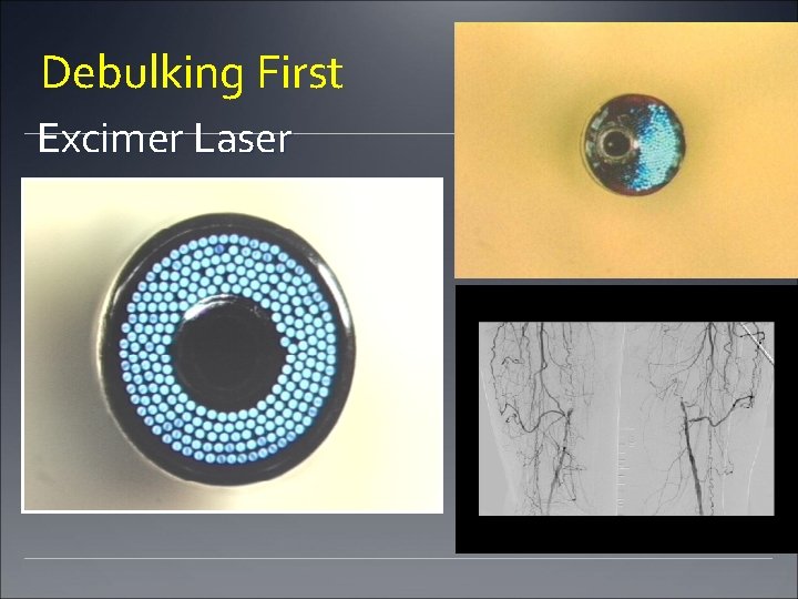 Debulking First Excimer Laser Debulking First Excimer Laser