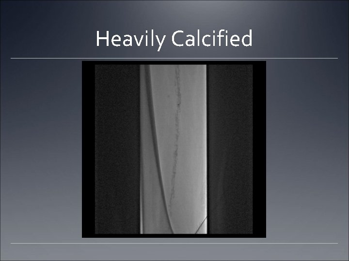 Heavily Calcified Heavily Calcified