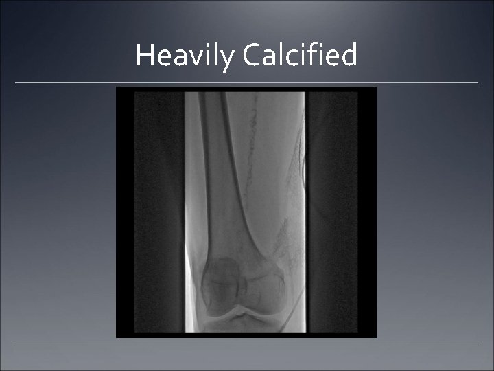 Heavily Calcified Heavily Calcified