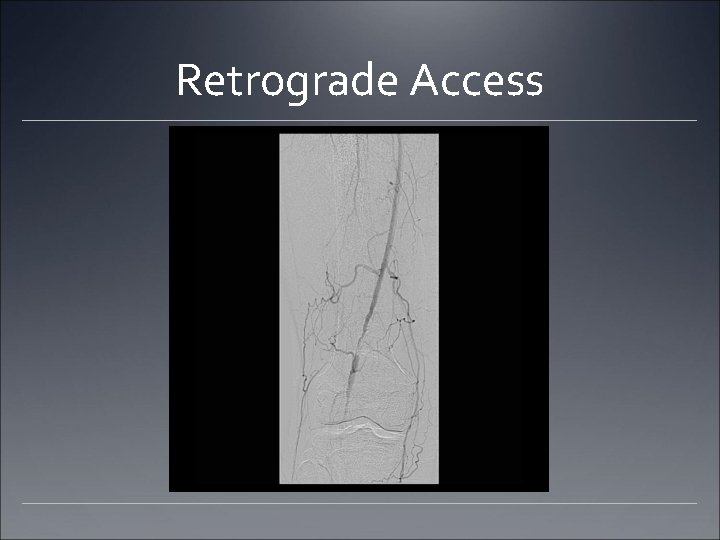 Retrograde Access Retrograde Access