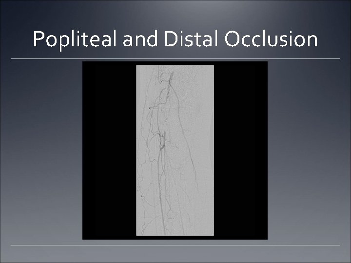 Popliteal and Distal Occlusion Popliteal and Distal Occlusion