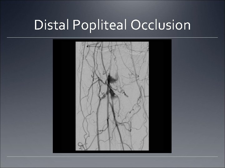 Distal Popliteal Occlusion Distal Popliteal Occlusion