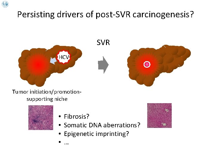 Persisting drivers of post-SVR carcinogenesis? SVR HCV Tumor initiation/promotionsupporting niche • • Fibrosis? Somatic