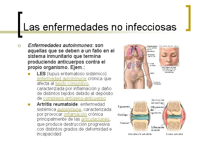Las enfermedades no infecciosas ¡ Enfermedades autoinmunes: son aquellas que se deben a un