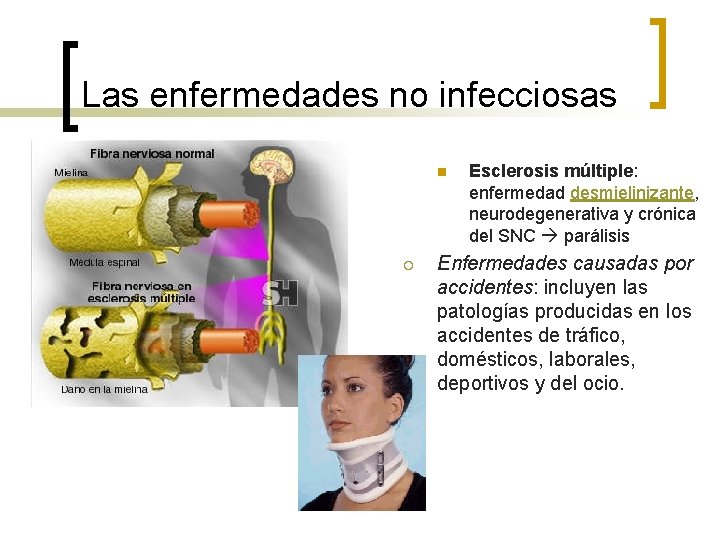 Las enfermedades no infecciosas n ¡ Esclerosis múltiple: enfermedad desmielinizante, neurodegenerativa y crónica del