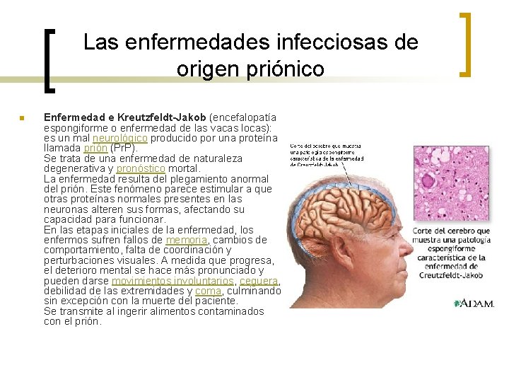 Las enfermedades infecciosas de origen priónico n Enfermedad e Kreutzfeldt-Jakob (encefalopatía espongiforme o enfermedad