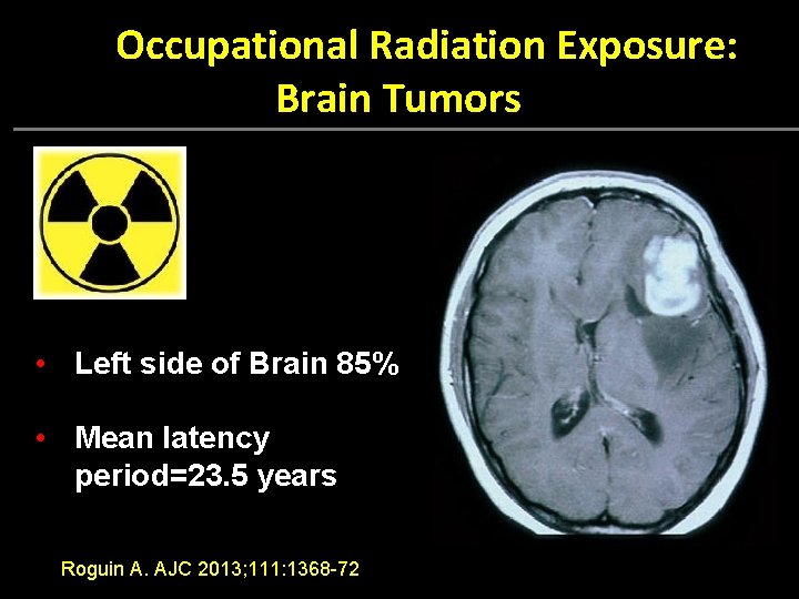  Occupational Radiation Exposure: Brain Tumors • Left side of Brain 85% 12% 16%